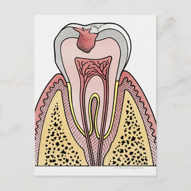 Cross section illustration showing tooth decay postcard (Front)