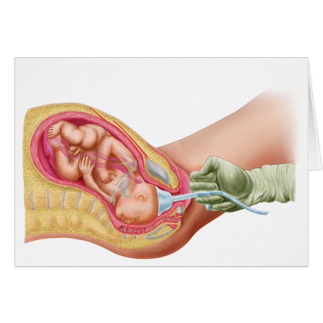Delivery Of Fetus Using Vacuum Extraction (Front Horizontal)