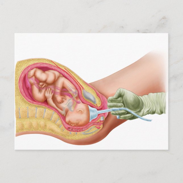 Delivery Of Fetus Using Vacuum Extraction Postcard (Front)