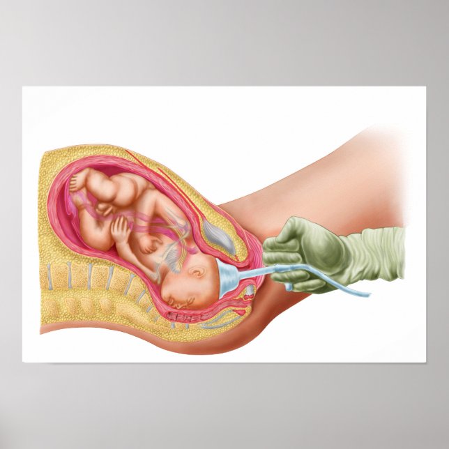 Delivery Of Fetus Using Vacuum Extraction Poster (Front)