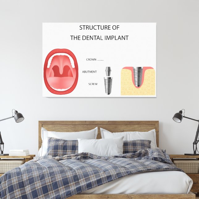 Dental implant structure canvas print (Insitu(Bedroom))