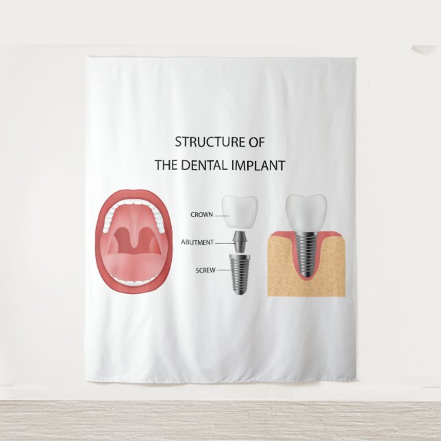 Dental implant structure tapestry (Front)
