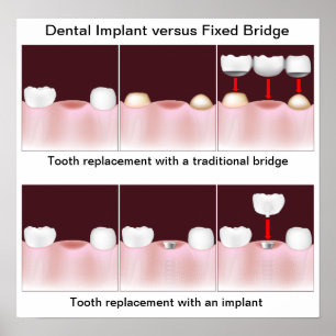 Dental implant versus bridge Poster