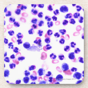 Dessous-de-verre Infection de staphylocoque