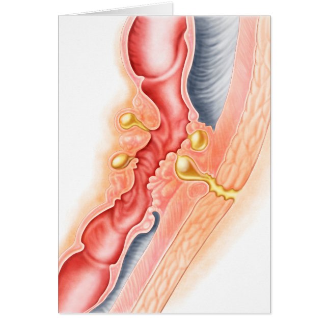 Development Of Fistula (Front)