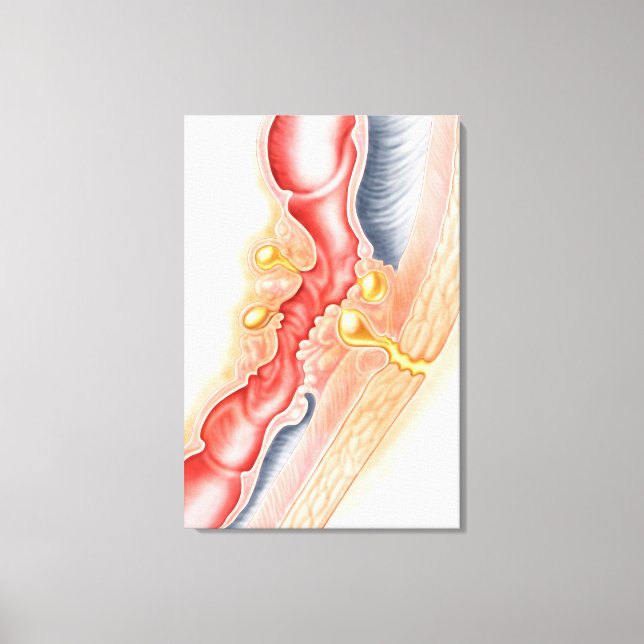 Development Of Fistula Canvas Print (Front)