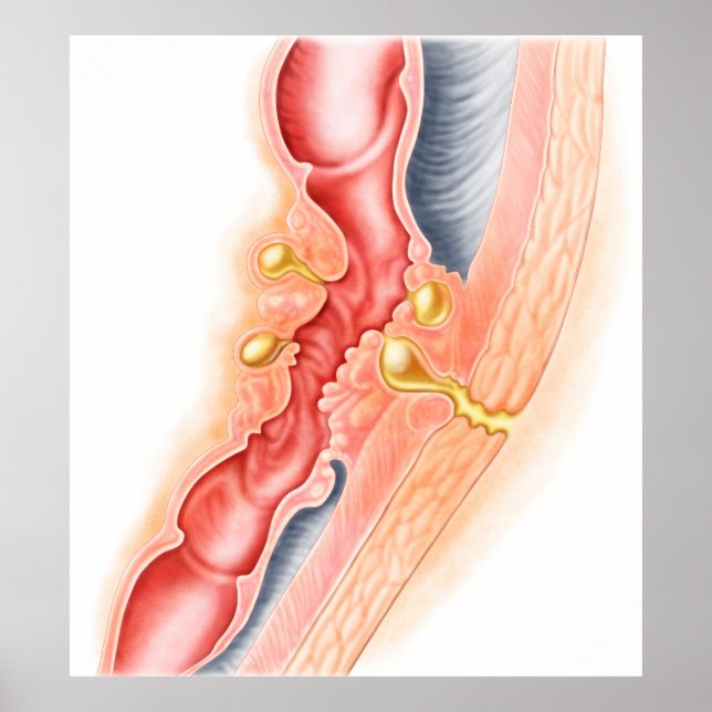 Development Of Fistula Poster (Front)