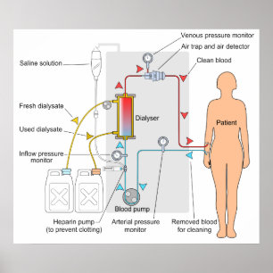 Diagram of a Haemodialysis Medical Treatment Poster