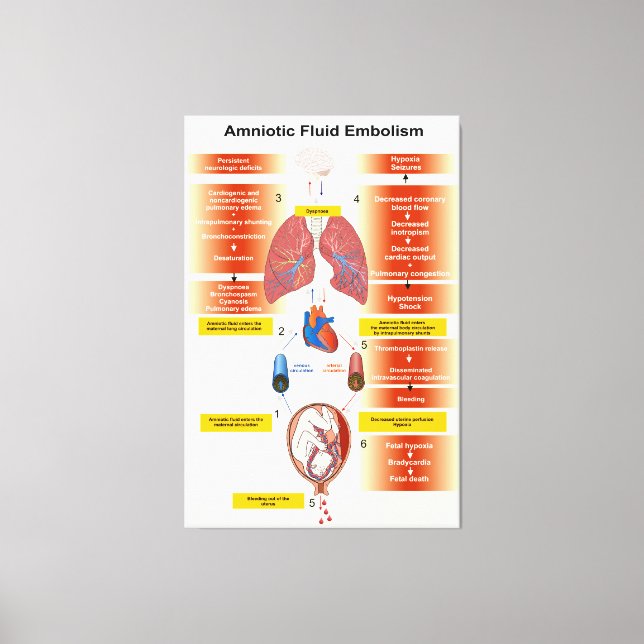 Diagram of an Amniotic Fluid Embolism AFE Canvas Print (Front)