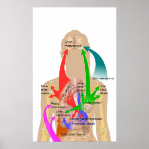 Diagram of Metastasis Sites for Common Cancers Poster