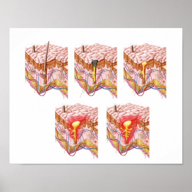 Different Types Of Acne Poster (Front)