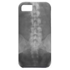 Digital X-Ray Art iPhone 5 Case