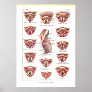 Diseases of Larynx Anatomy Poster French