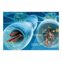 Disintegration of microtubules in a neuron