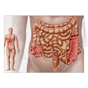 Diverticulite Dans La Région Du Colon Descendant