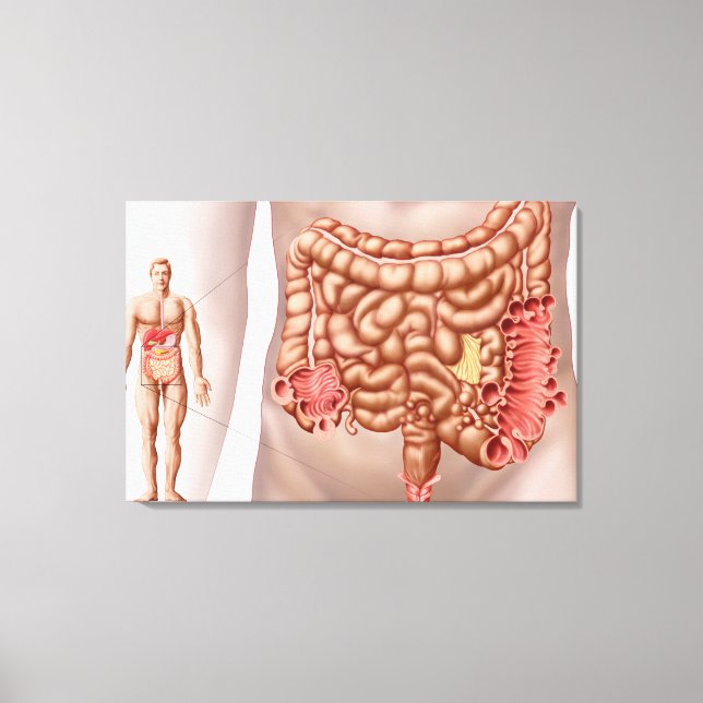 Diverticulitis In The Descending Colon Region Canvas Print (Front)