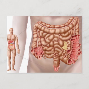 Diverticulitis In The Descending Colon Region Postcard
