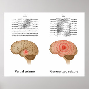 EEG in partial and generalized epilepsy Poster