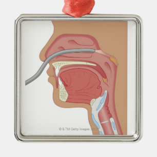 Endoscopy of the Nose Metal Ornament