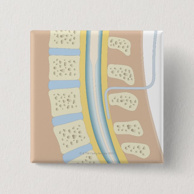 Epidural Anaesthesia 2 Inch Square Button (Front)