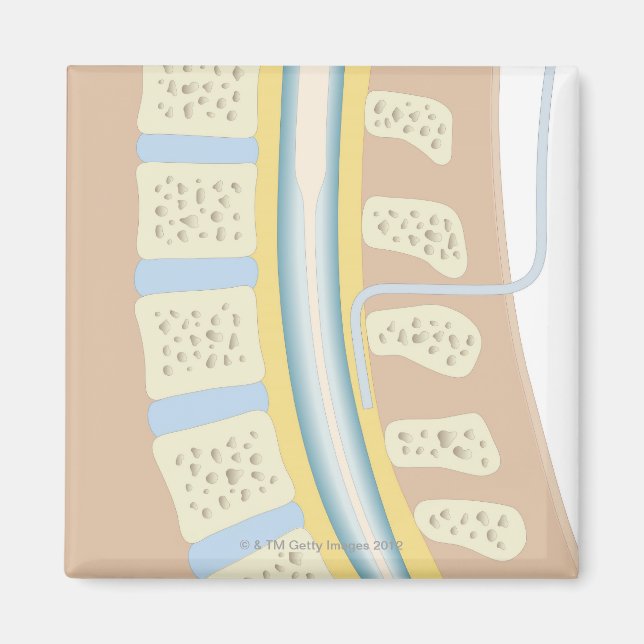 Epidural Anaesthesia Magnet (Front)