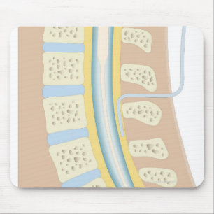 Epidural Anaesthesia Mouse Pad