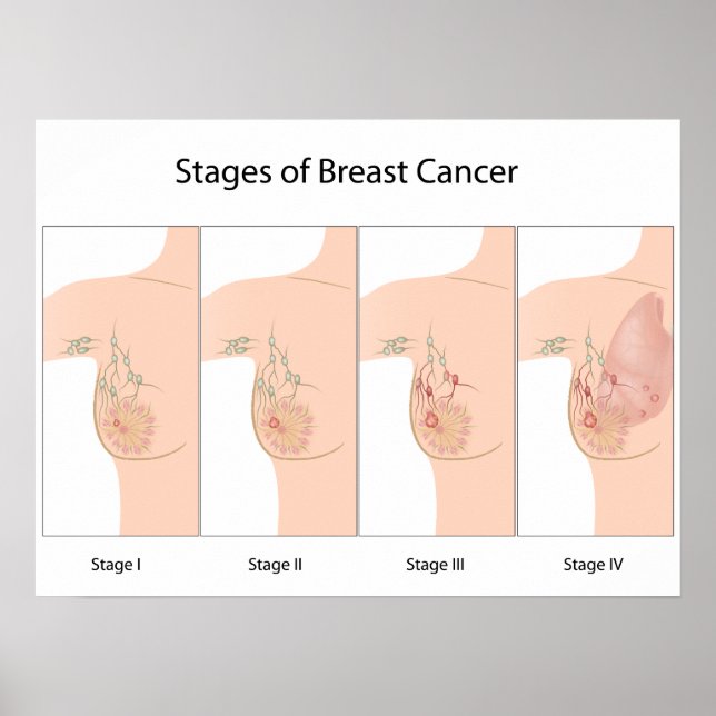 Étapes du cancer du sein Poster (Devant)