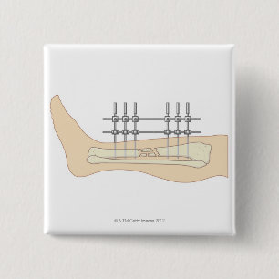 External Fixator 2 Inch Square Button