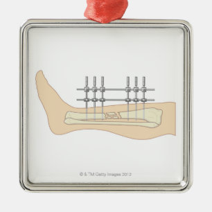 External Fixator Metal Ornament