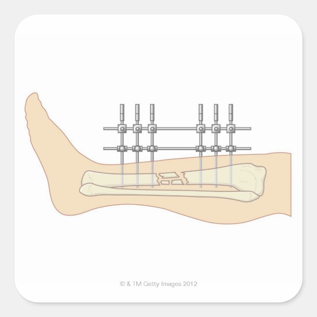 External Fixator Square Sticker (Front)