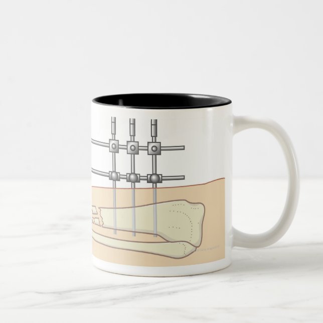 External Fixator Two-Tone Coffee Mug (Right)