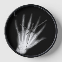 Extra Digit X-ray Left Hand