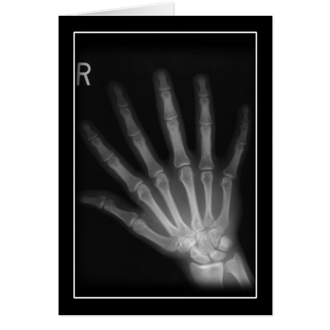 Extra Digit X-ray Right Hand (Front)