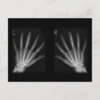 Extra Digit X-ray Right & Left Hands