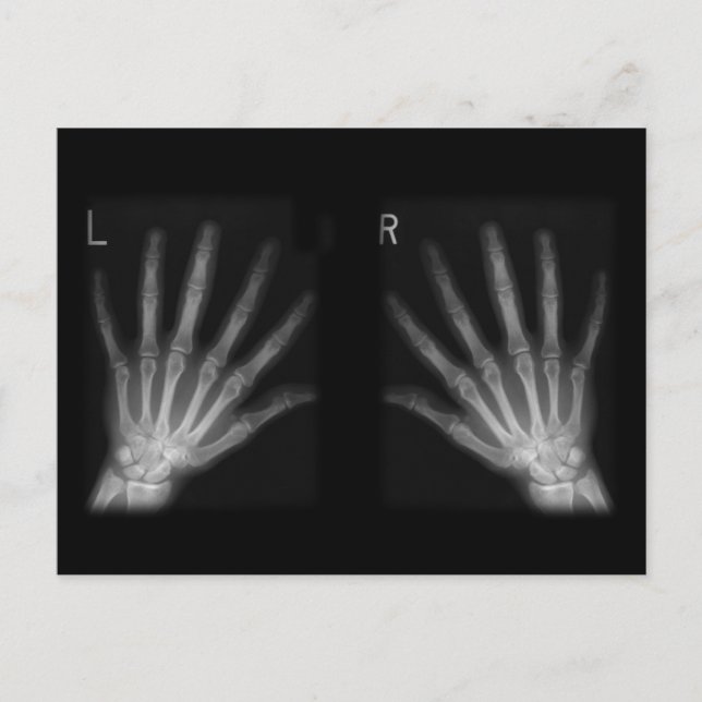 Extra Digit X-ray Right & Left Hands Postcard (Front)