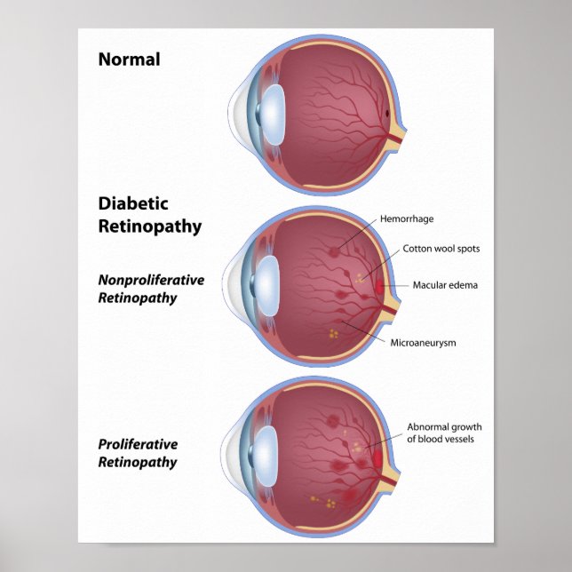 Eye disease Diabetic retinopathy Poster (Front)
