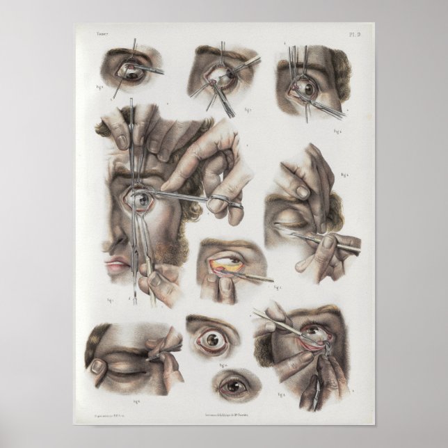 Eye Surgery Technique Vintage Anatomy Print (Front)