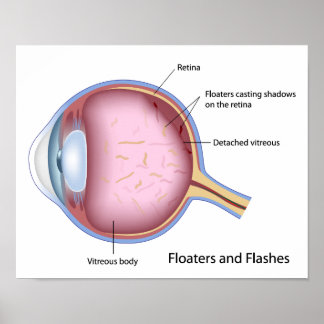 Floaters and Flashes eye disease Poster