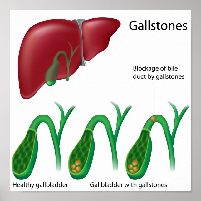Gallstones and Liver Poster (Front)