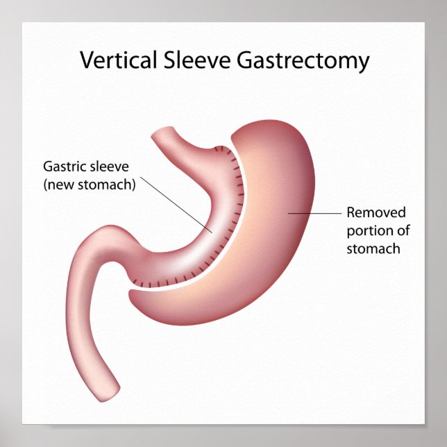 Gastric sleeve weight loss surgery Poster (Front)