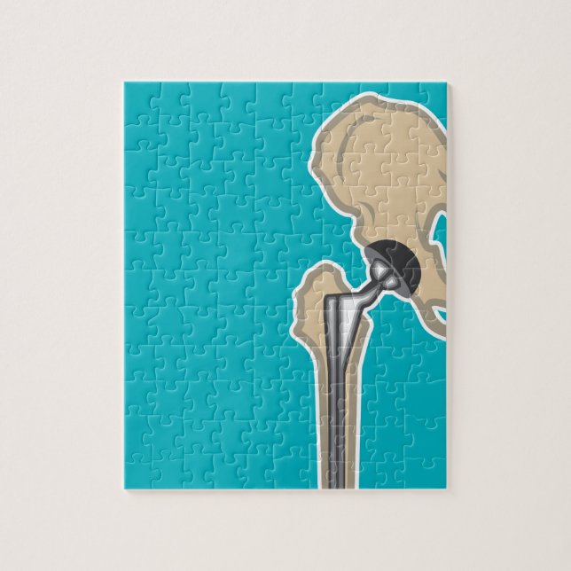 Hip Joint Replacement Jigsaw Puzzle (Vertical)