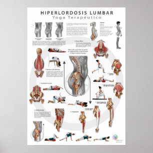 Hiperlordosis - definition, causes and treatment poster