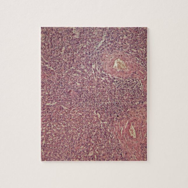 Human spleen with chronic myelogenous leukaemia jigsaw puzzle (Vertical)