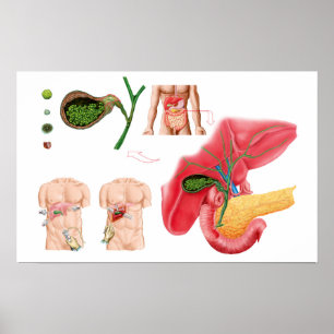 Illustration Depicting Cholecystectomy Poster