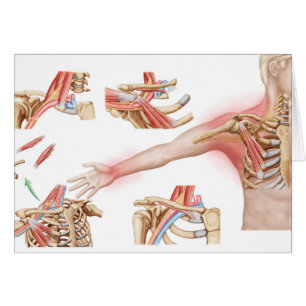 Illustration Médicale détaillant le débouché