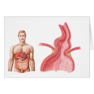 Illustration Médicale D'Une Hernie Hiatal Dans