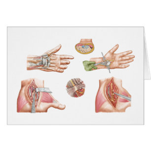Illustration Médicale montrant le tunnel carpal