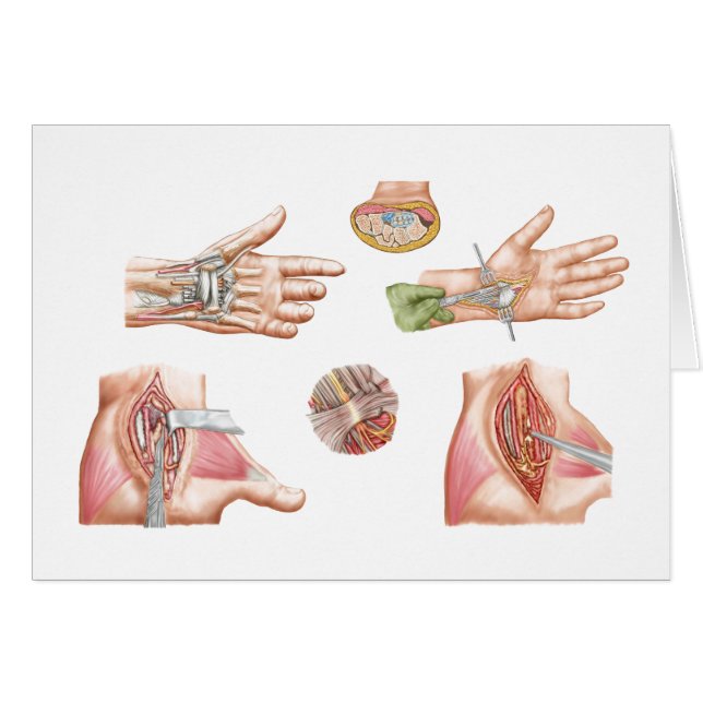 Illustration Médicale montrant le tunnel carpal (Devant horizontal)