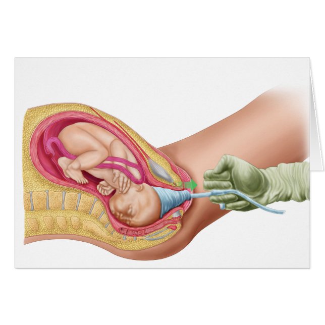 Illustration Montrant La Livraison Du Foetus 1 (Devant horizontal)