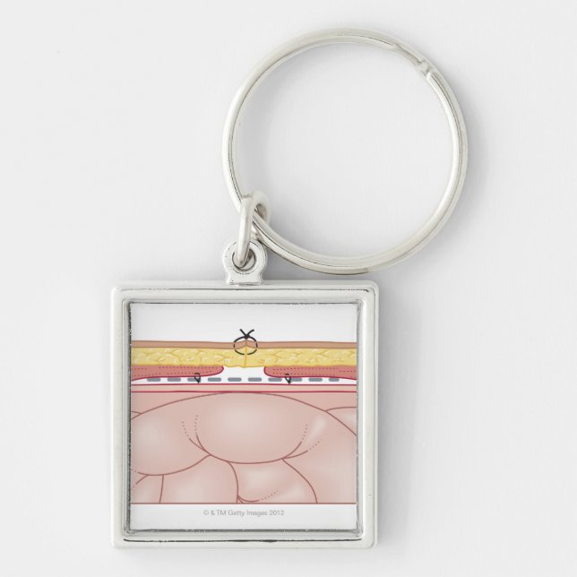Illustration of a Hernia Keychain (Front)